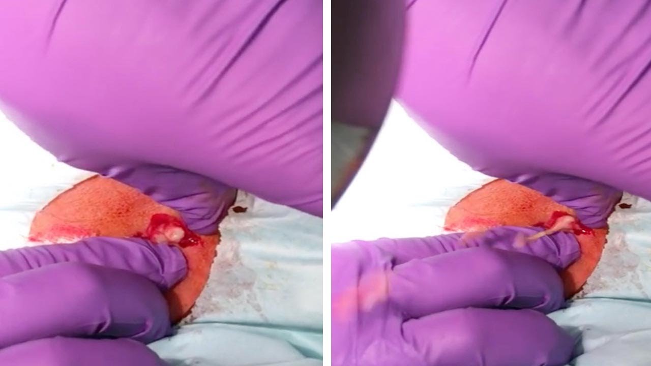 Huge Cyst Explosion
