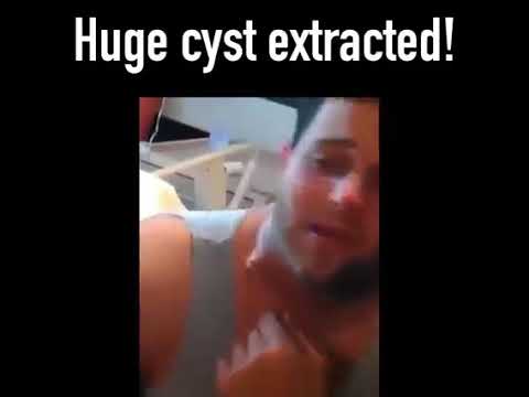 Huge Cyst extracted so satisfying ?? #shorts #pimplepopping