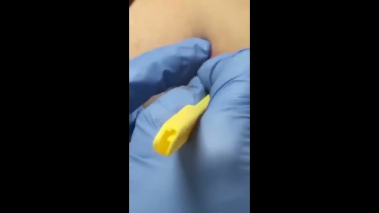 Huge cyst is being popped  Prepare yourself!