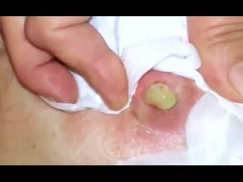 Huge cyst on back popping video. ! Popping Biggest Back Zits!