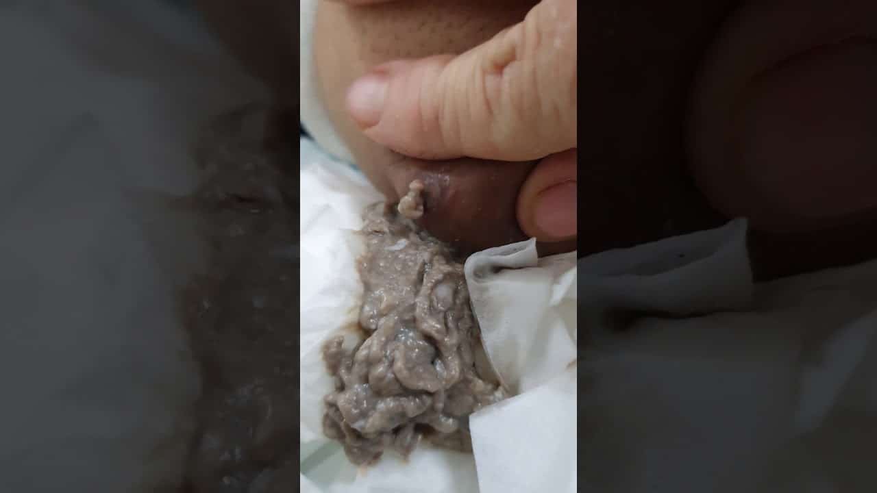 Huge Cyst on Elbow