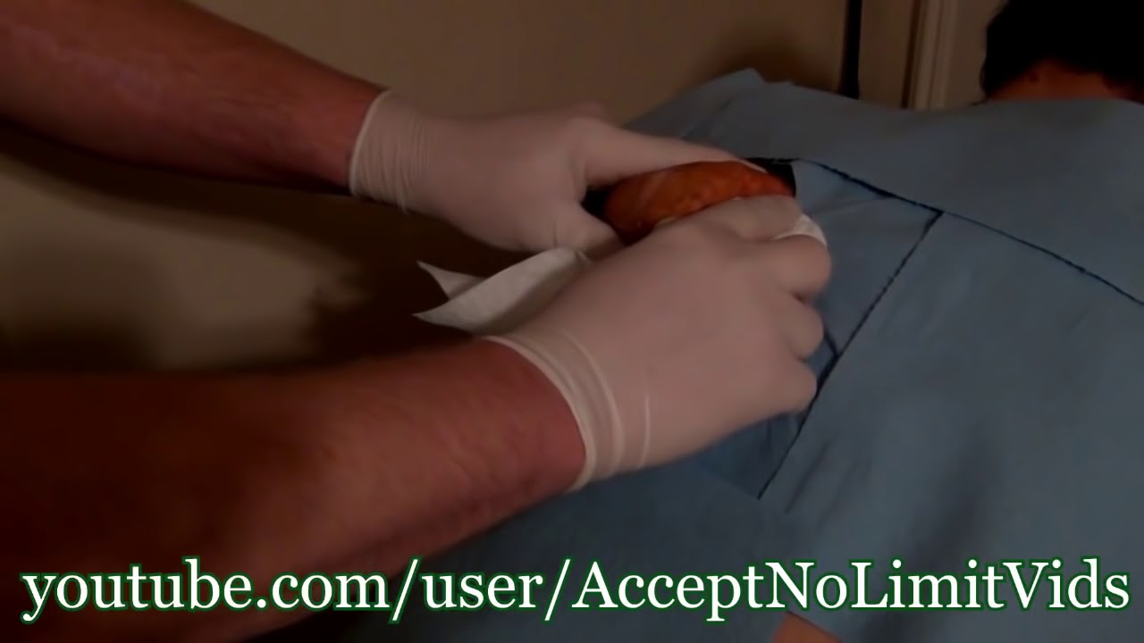 Huge Cyst Pop 30 Years Old | Docpimplepopper.com