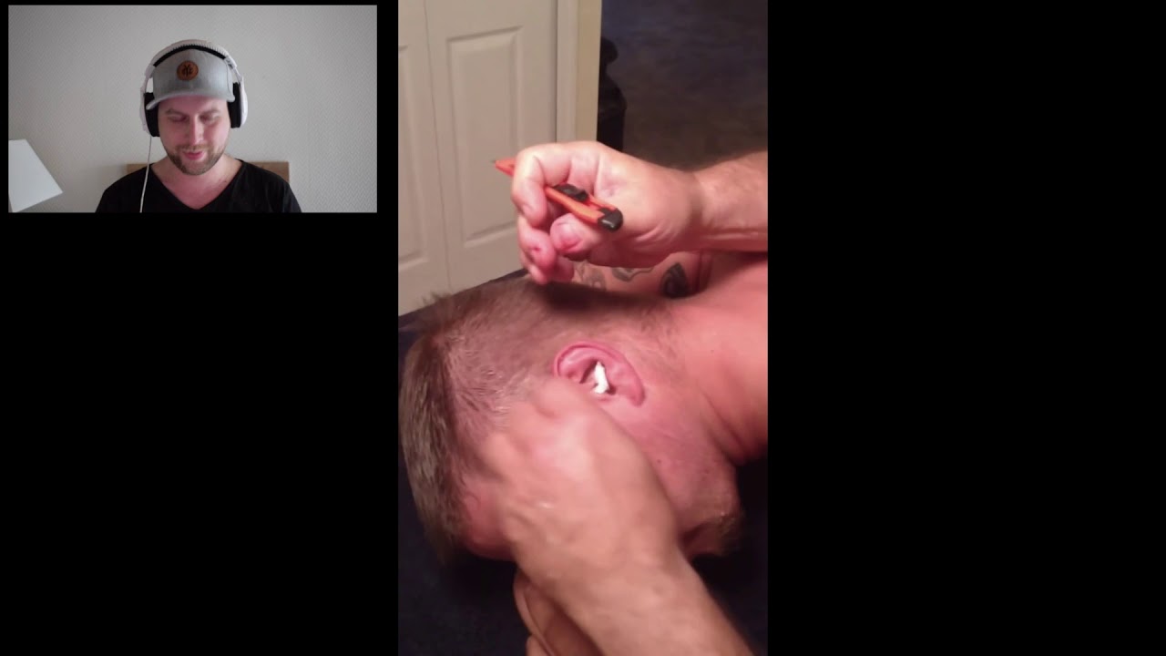 huge cyst pop near the ear ! cyst removal!
