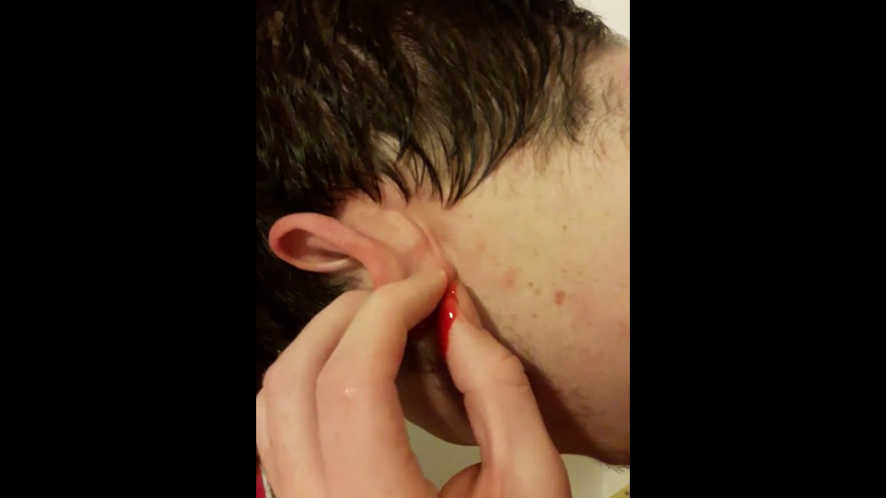 Huge cyst popped
