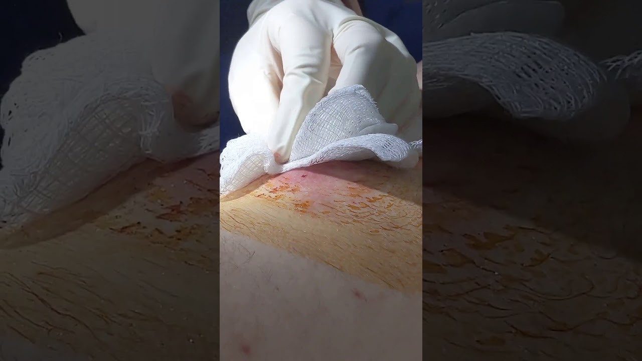 Huge Cyst Popping