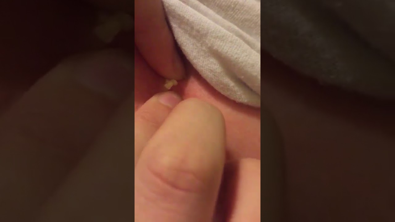 Huge cyst popping. Blackhead Squeezed Pimple Removal