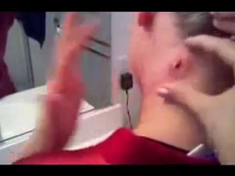 HUGE CYST POPPING || POPPING NECK CYST || CYST EXPLODES ON NECK