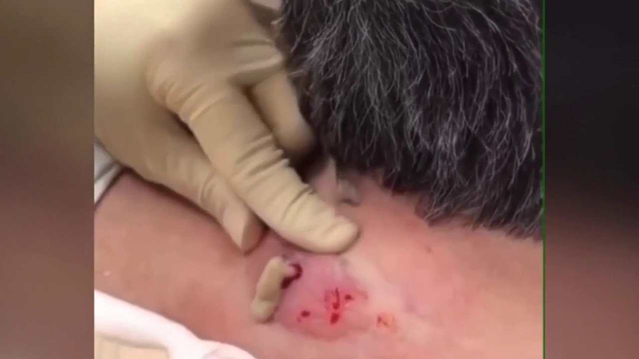 Huge Cyst Popping The Most Satisfying Giant Blackheads Removal