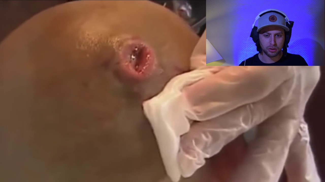 huge CYST removal on the scalp of this man !!! sebaceous cyst