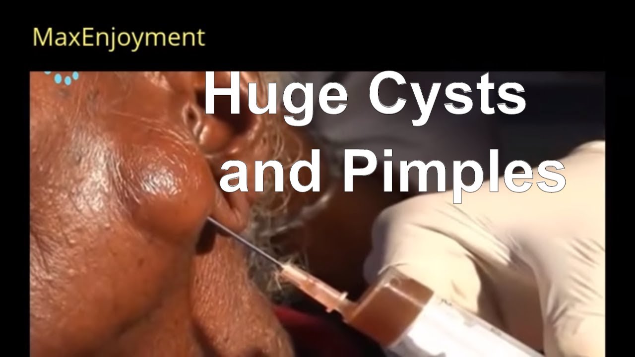 Huge Cysts and Pimple Popping:Try not to look away!
