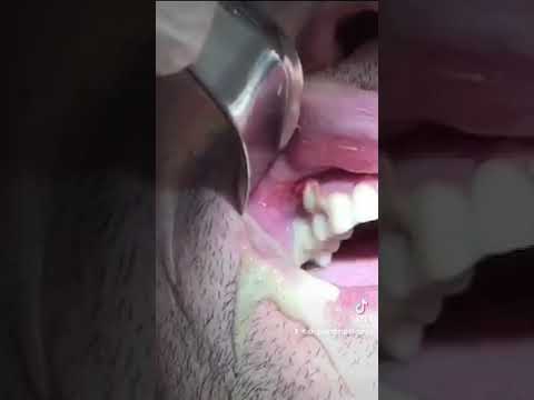 🛑HUGE dental infection and abscess – PUS drainage #shorts