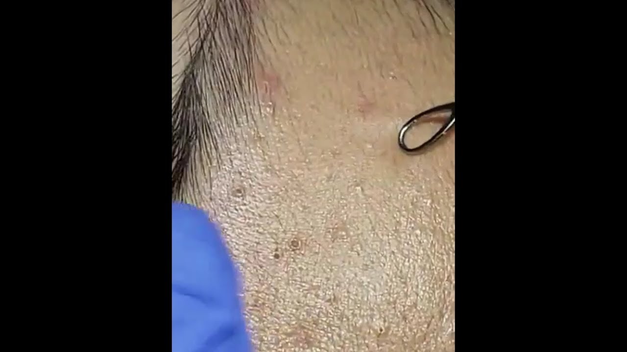 HUGE greasy blackheads on face get squeezed with precision! ASMR Pimple Popping