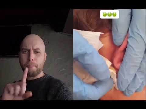 Huge infected cyst behind the ear !