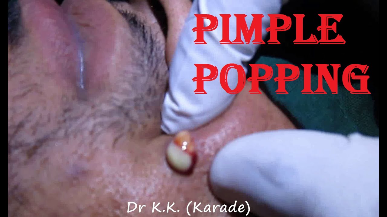 Huge Infected Pimple Popping on Face : Incision & Drainage of infected Cysts (INFLAMMATORY ACNE)
