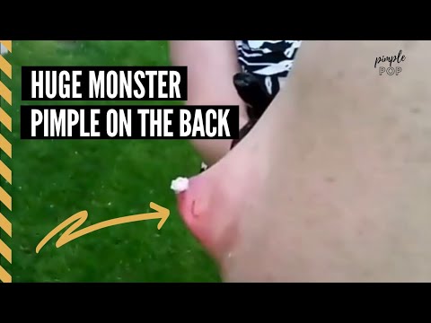 Huge Monster Pimple Popping On The Back (Satisfying pimple popping videos)
