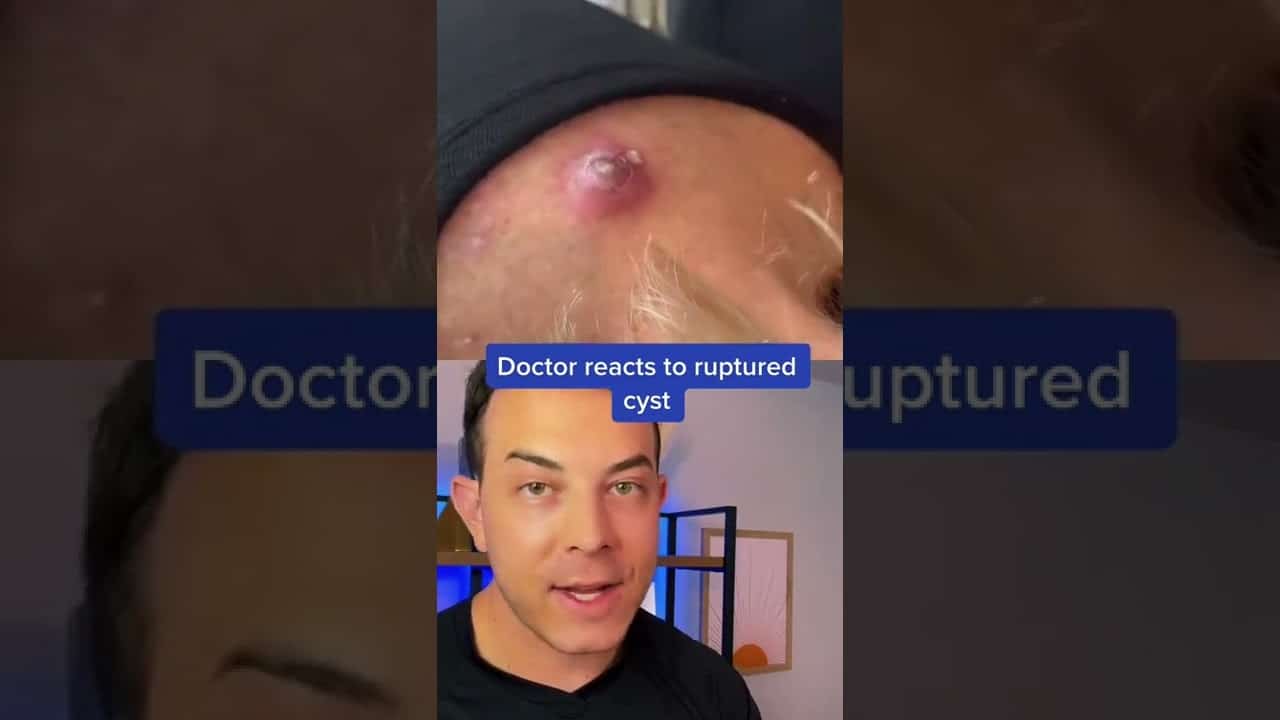HUGE Painful Cyst! Needs to pop | 208SkinDoc