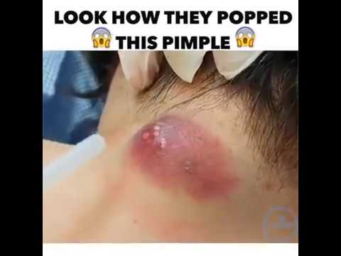 HUGE Pimple Cyst Pop 2018    WARNING    not for the faint hearted