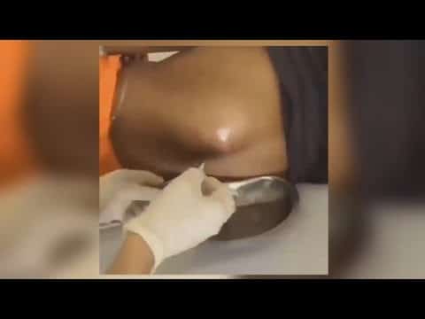 Huge pimple popping on the back // pimple, cyst, acne, Blackheads, Whitehead, oddly, boil popping up