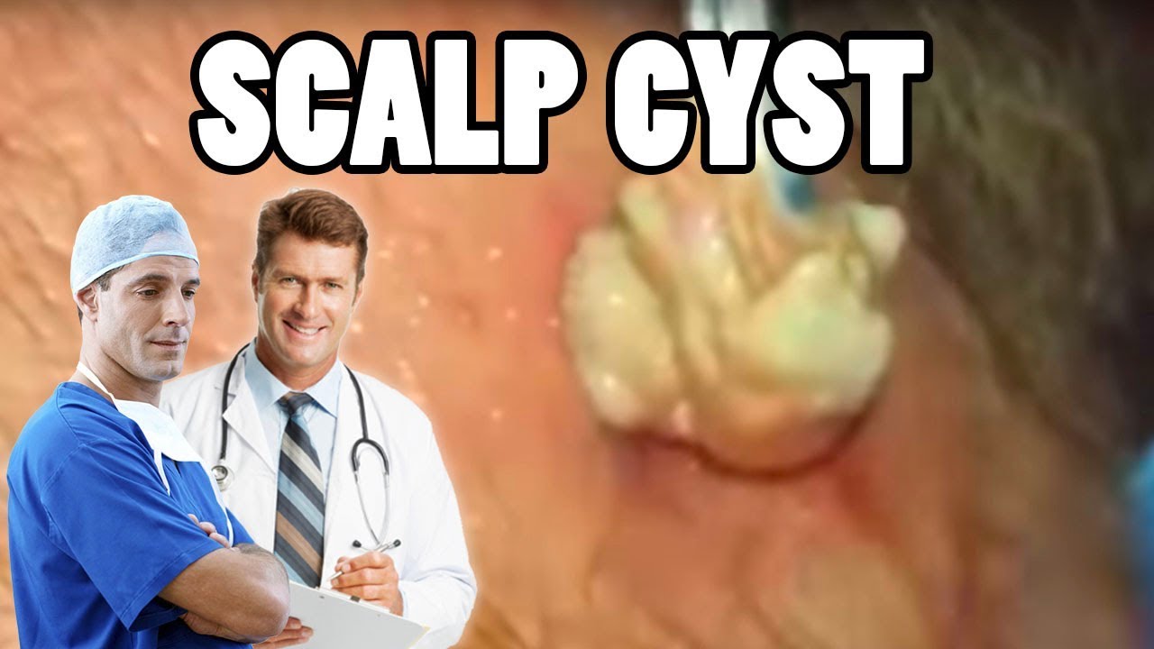 HUGE Scalp Pimple!  Pilar Cyst Removal Case Study!  ??