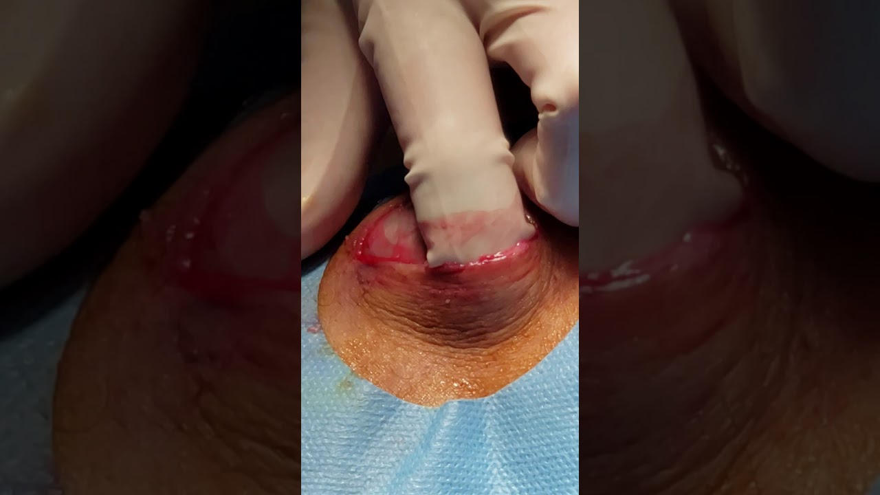 Huge sebaceous cysts removed from leg!