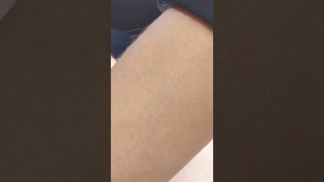 Huge Zit Cyst getting popped