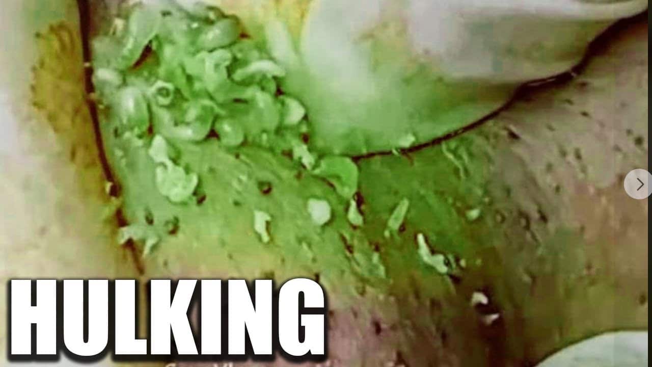 Hulking Pimple Pops!  Incredible Cysts, Abscesses, Carbuncles and More!