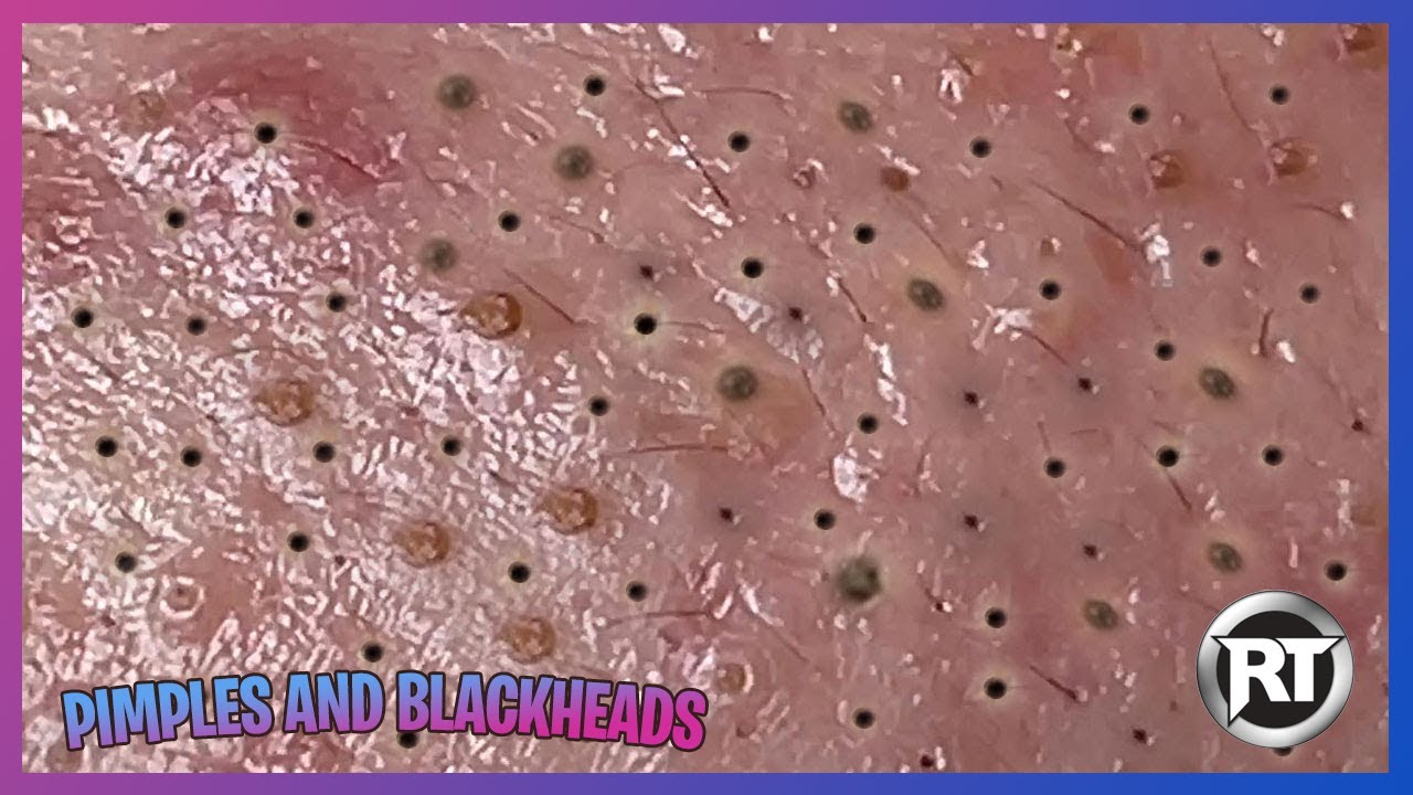 Humongous Pimple Popper and BlackHead – Compilation #4