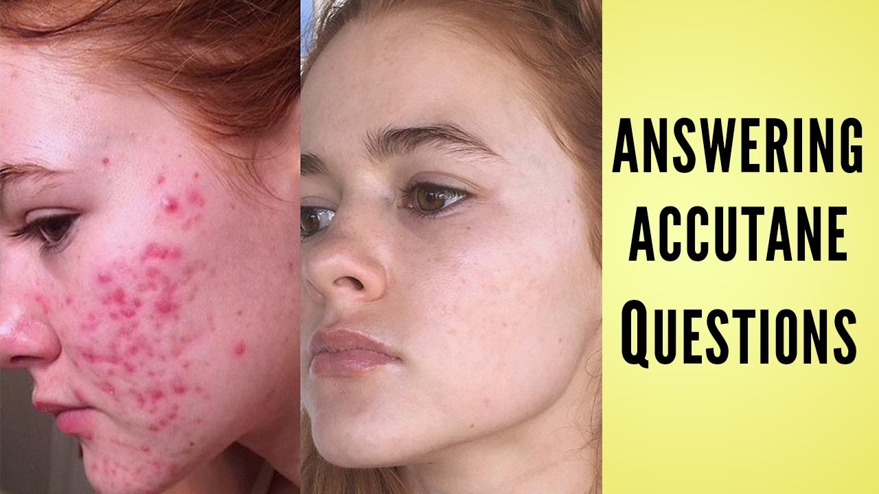 I ANSWER YOUR ACCUTANE QUESTIONS!