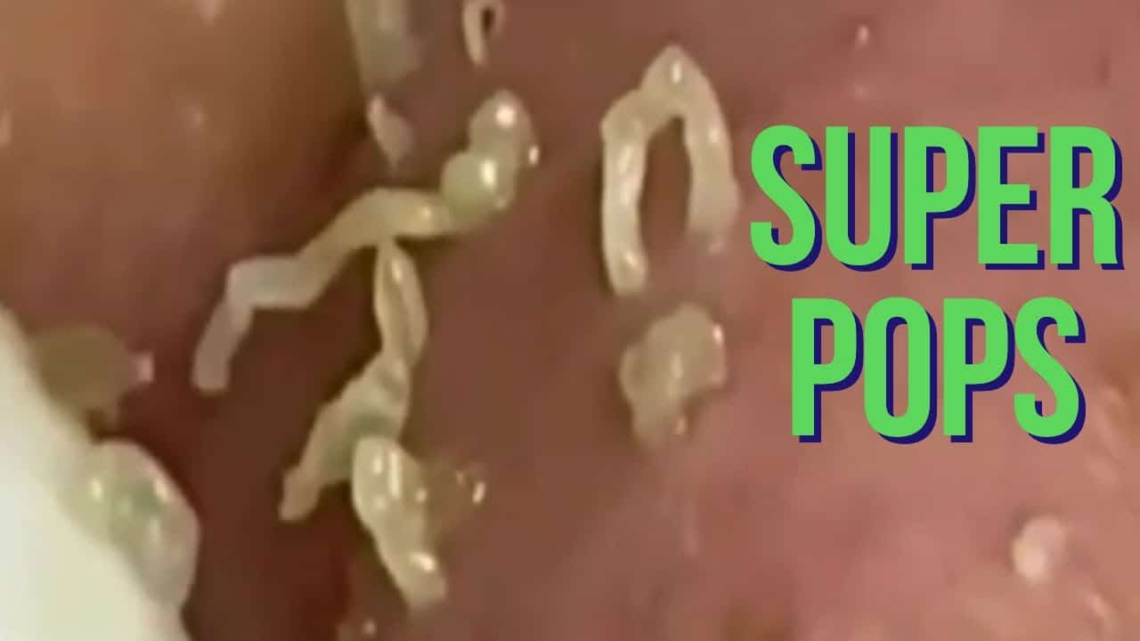 I Can't Remember A Better Pimple, Cyst, And Zit Popping Compilation Video