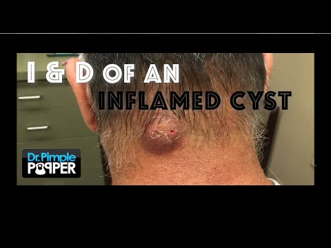 I & D of an inflamed cyst on the neck, with intro