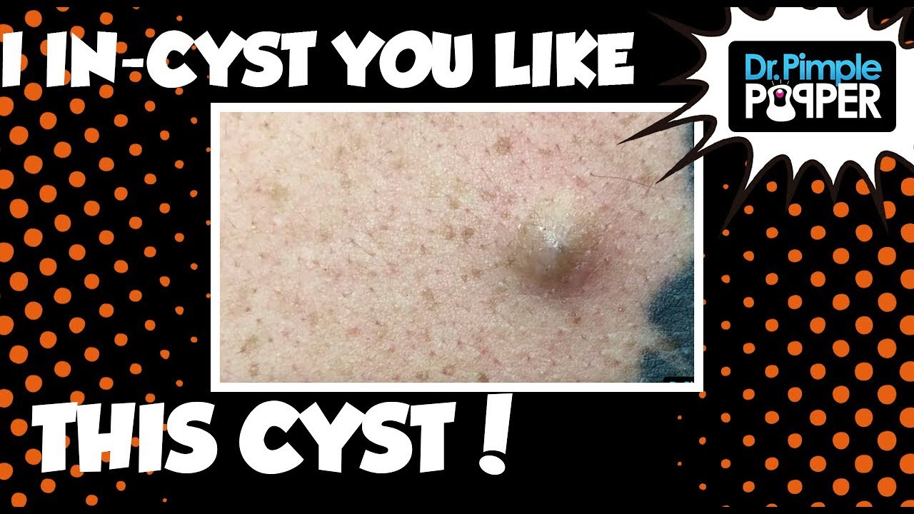 I Incyst you like this cyst!