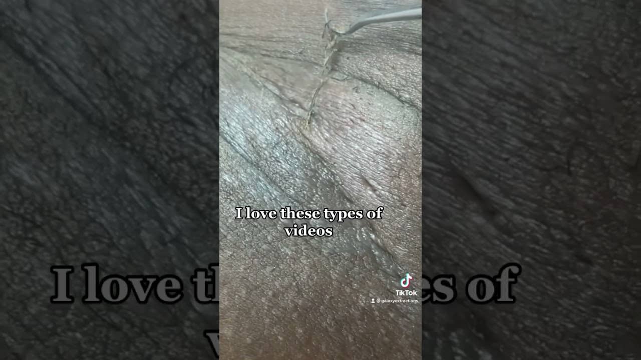 I love these types of videos 😌 #ingrownhairremoval #galaxyextractions #drpimplepopper