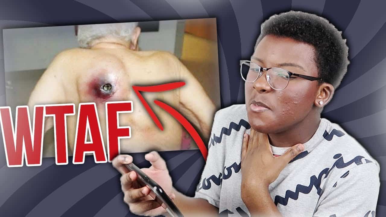 I Reacted to GROSS Pimple Popping and Ingrown Hair Removal Videos (WTAF)