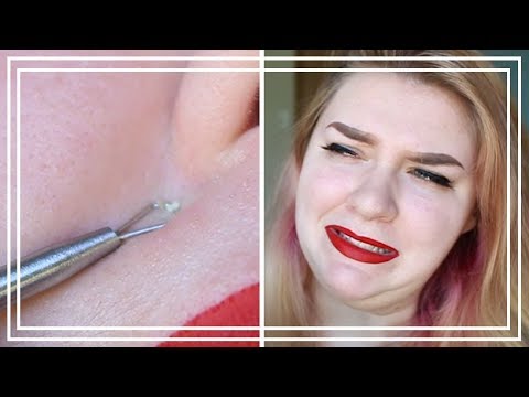 I Tried an At Home Pimple Popping Kit