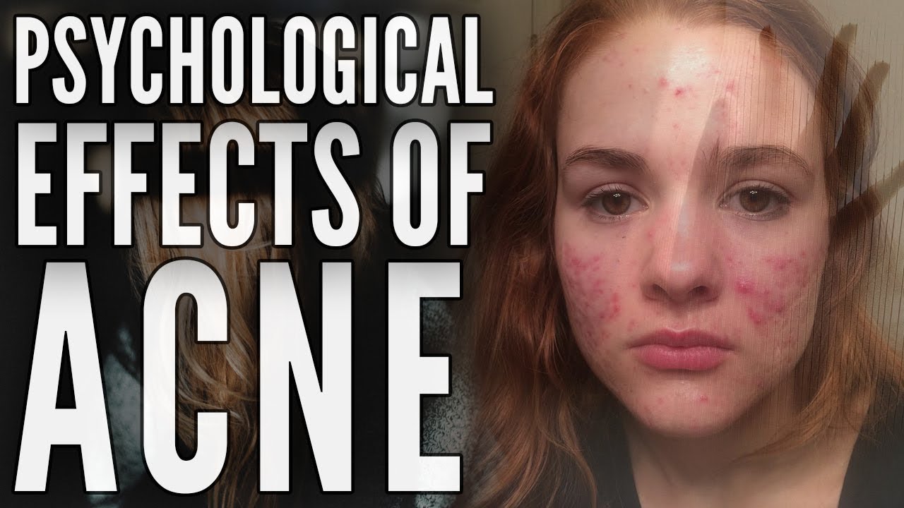“I would Rather Die” How Acne Affected my Life