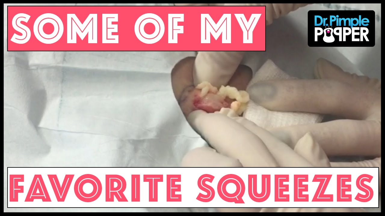 In Memory of some of My Favorite Squeezes: Dr Pimple Popper