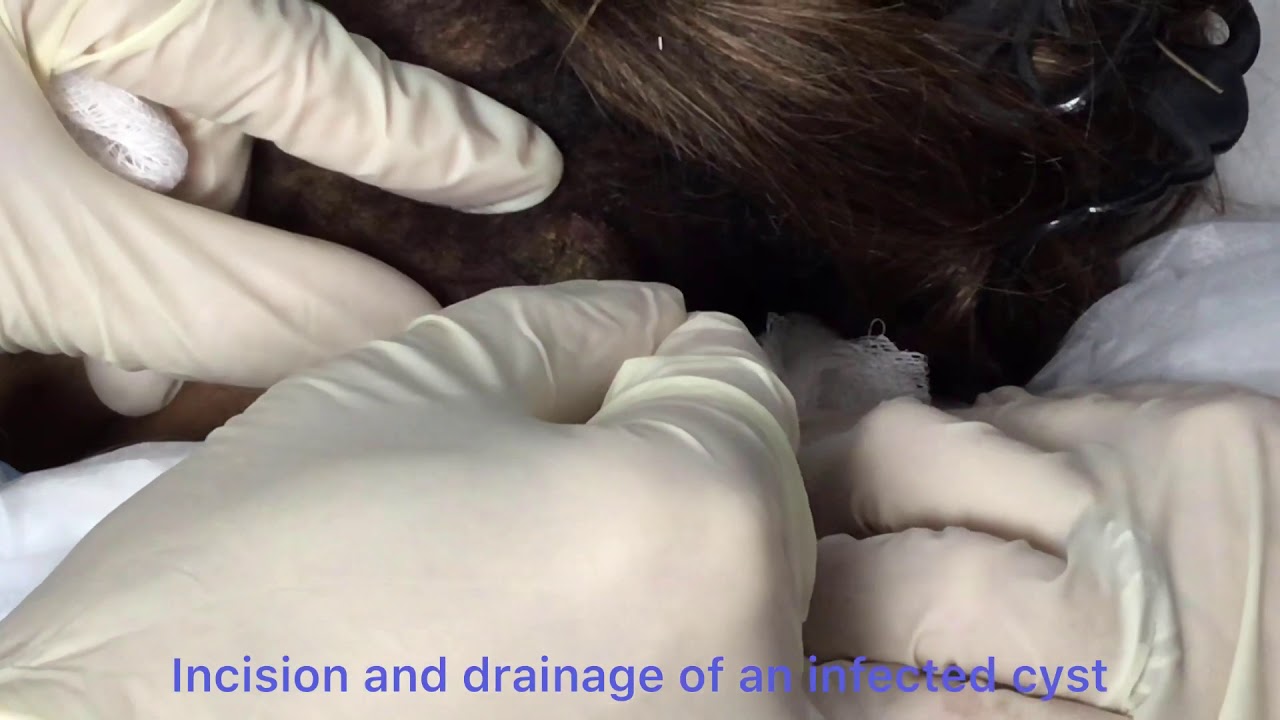 Incision and drainage of an infected cyst