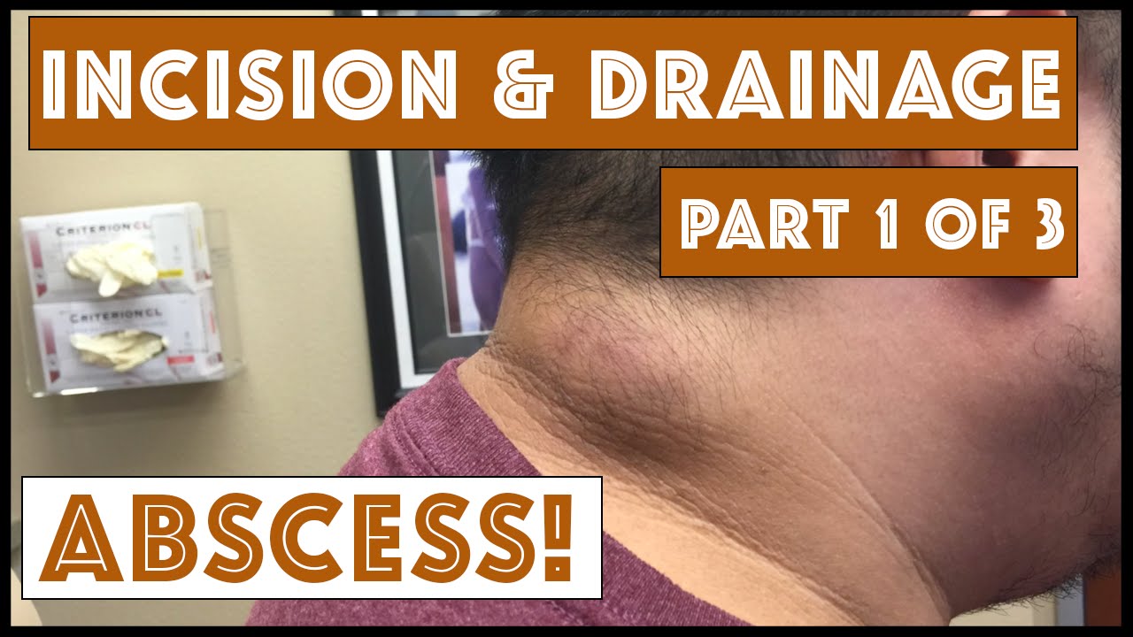 Incision & Drainage of an Infected Cyst – Part 1 of 3