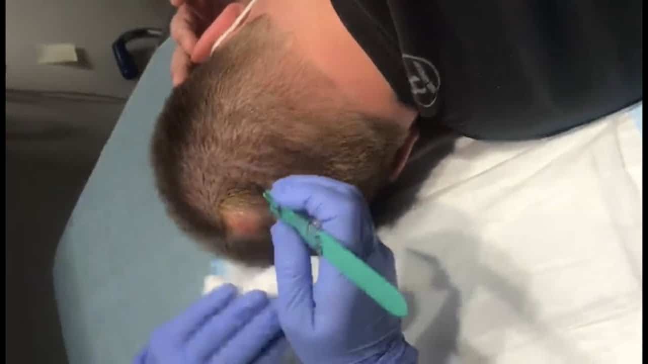 Incredible Cyst Removal On Back Of Head