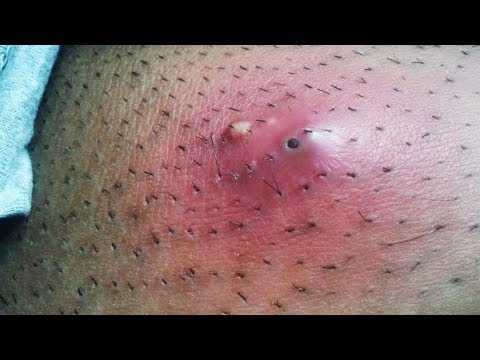 India’s Best Cyst Busting!  Surgery, Infections & Popping!
