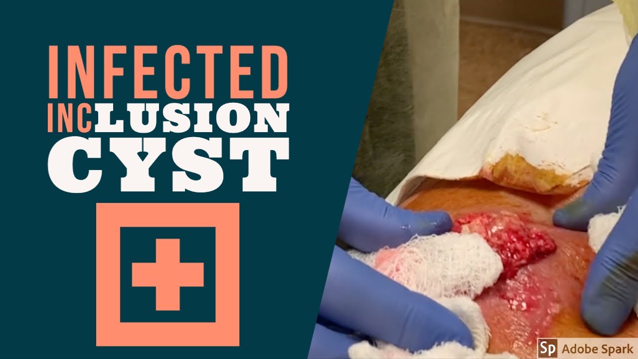 infected back inclusion cyst