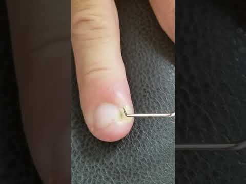 Infected cuticle.  Pimple Pop.  Pus gush. Must see