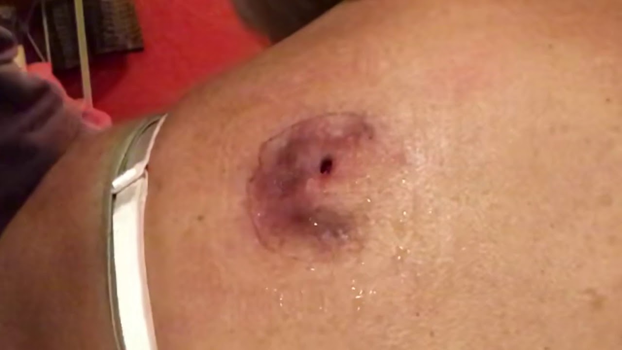 Infected Cyst – Day 67 – Dry Plus Darkness – Nurse Wink!