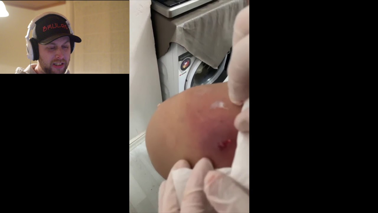 Infected cyst flying around:cyst explosion