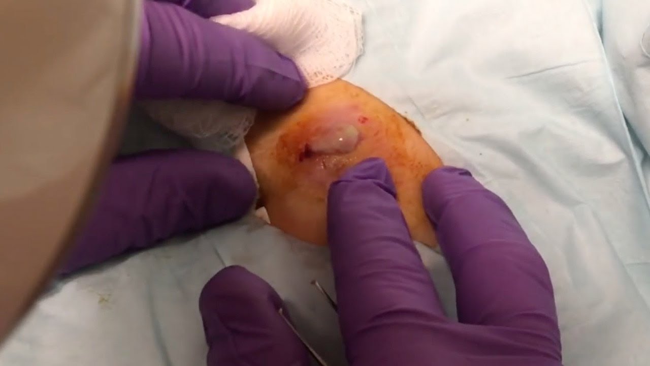 Infected Cyst Popped On Chest