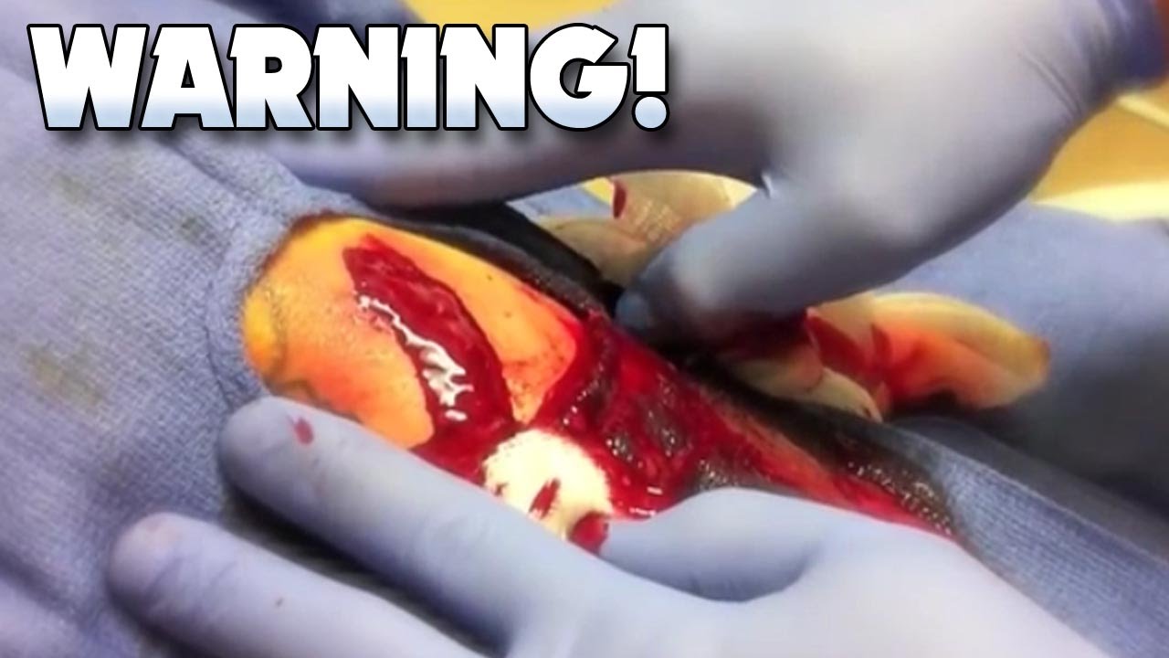Infected Cyst Popping & Worst Infections on YouTube