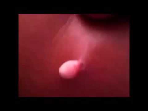 Infected Pimple Popping 2014   YouTube