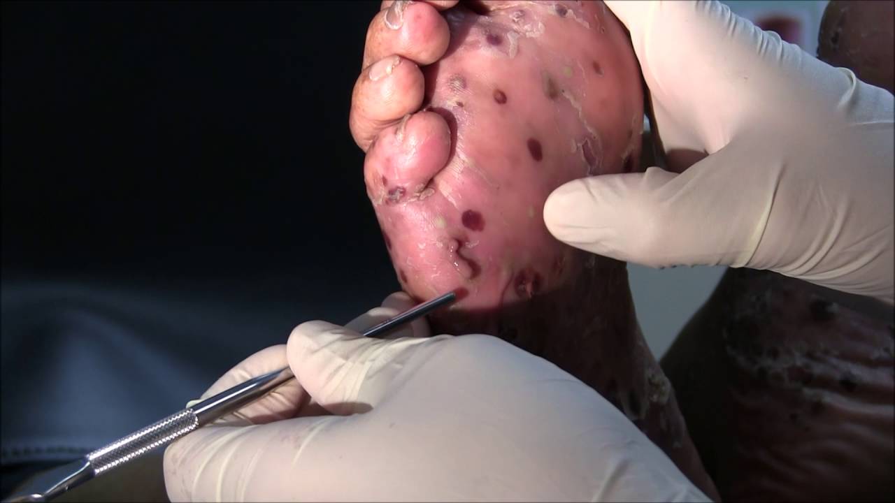 Infected Pustular Lesions of the Foot