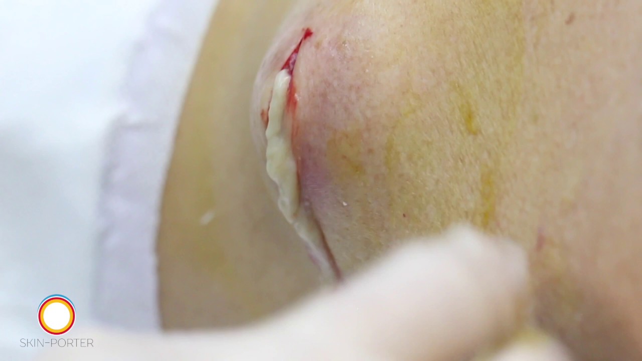 Infected sebaceous cyst removal