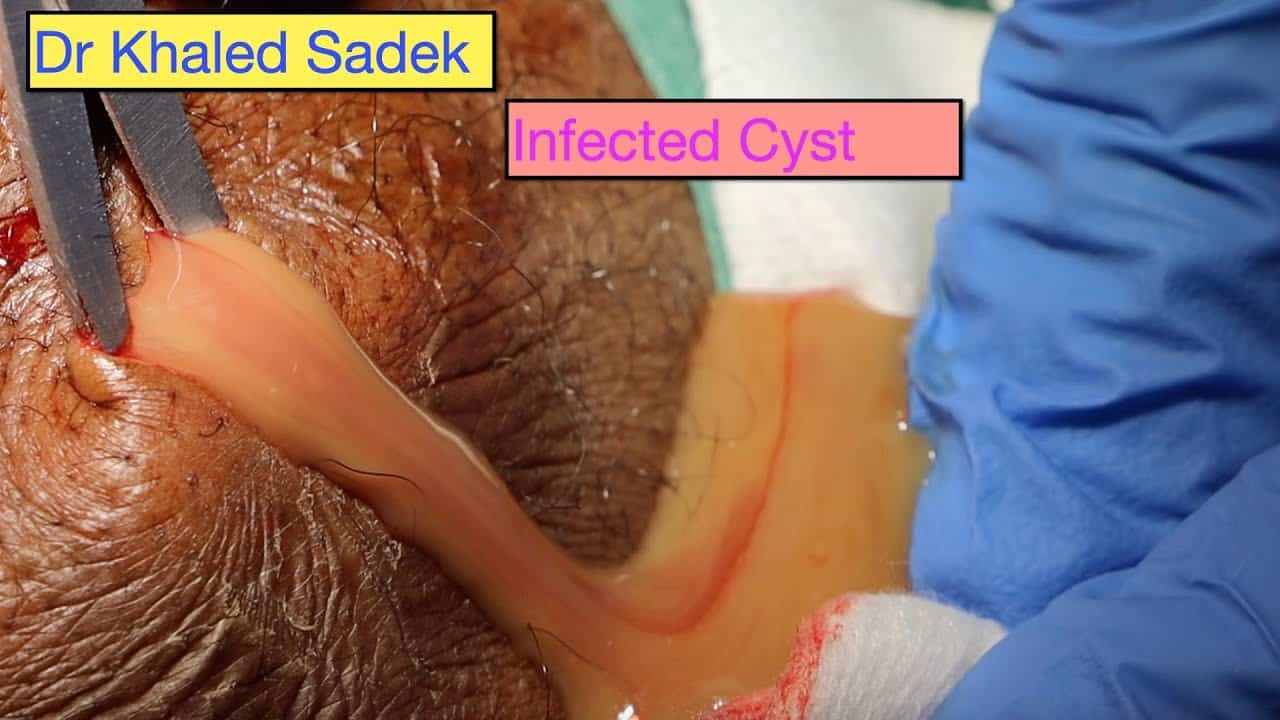 Infected Waterfall Cyst. Dr Khaled Sadek. LipomaCyst.com